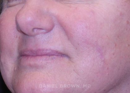 Mole Removal Before & After Patient #10352