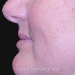 Mole Removal Before & After Patient #10352