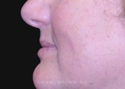 Mole Removal Before & After Patient #10352