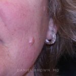 Mole Removal Before & After Patient #10352