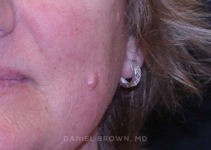 Mole Removal Before & After Patient #10352