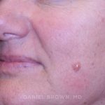 Mole Removal Before & After Patient #10352