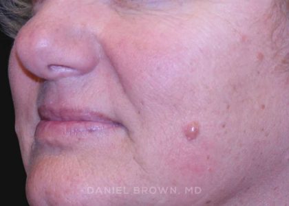 Mole Removal Before & After Patient #10352