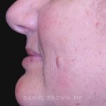 Mole Removal Before & After Patient #10352