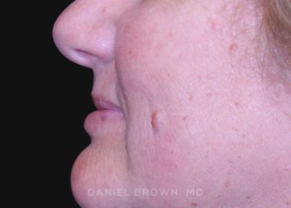 Mole Removal Before & After Patient #10352
