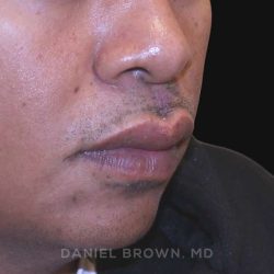 Mole Removal Before & After Patient #10357