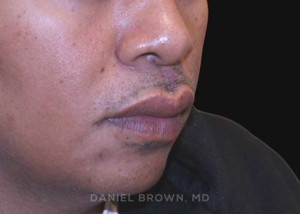 Mole Removal Before & After Patient #10357