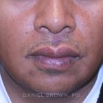Mole Removal Before & After Patient #10357