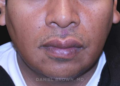 Mole Removal Before & After Patient #10357