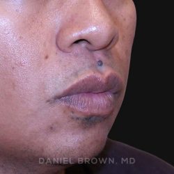 Mole Removal Before & After Patient #10357