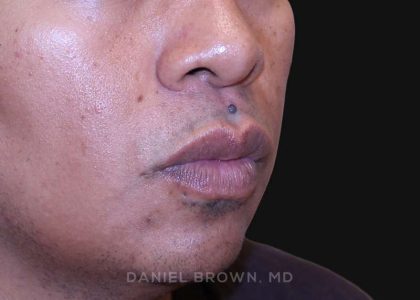 Mole Removal Before & After Patient #10357