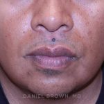 Mole Removal Before & After Patient #10357