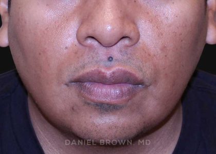 Mole Removal Before & After Patient #10357