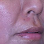 Mole Removal Before & After Patient #10360