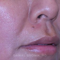 Mole Removal Before & After Patient #10360