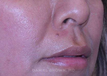 Mole Removal Before & After Patient #10360