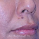 Mole Removal Before & After Patient #10360