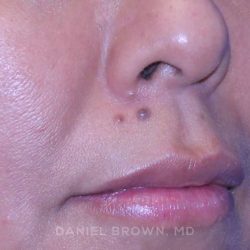 Mole Removal Before & After Patient #10360