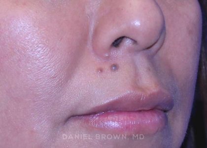 Mole Removal Before & After Patient #10360