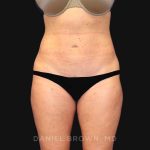 Mini Tummy Tuck Before & After Patient #10322