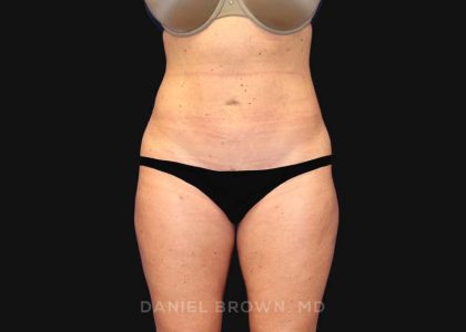 Mini Tummy Tuck Before & After Patient #10322