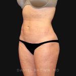 Mini Tummy Tuck Before & After Patient #10322