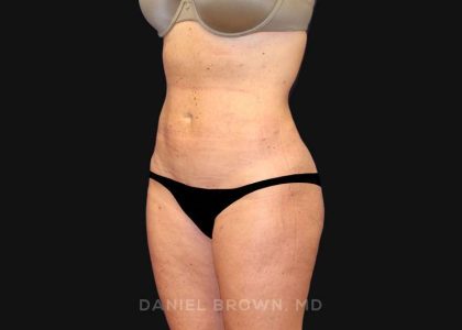 Mini Tummy Tuck Before & After Patient #10322