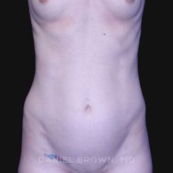 Mini Tummy Tuck Before & After Patient #10331