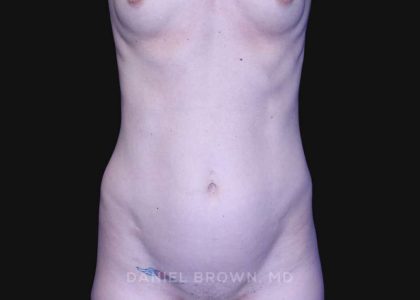 Mini Tummy Tuck Before & After Patient #10331