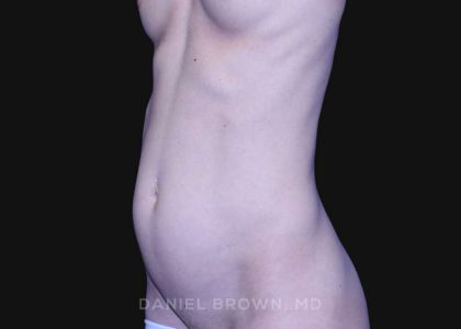 Mini Tummy Tuck Before & After Patient #10331