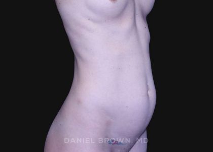 Mini Tummy Tuck Before & After Patient #10331