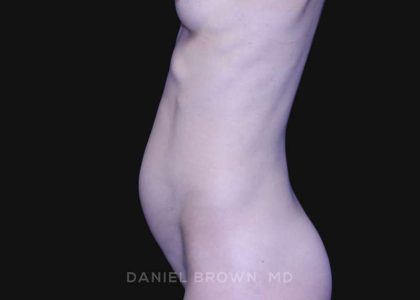 Mini Tummy Tuck Before & After Patient #10331