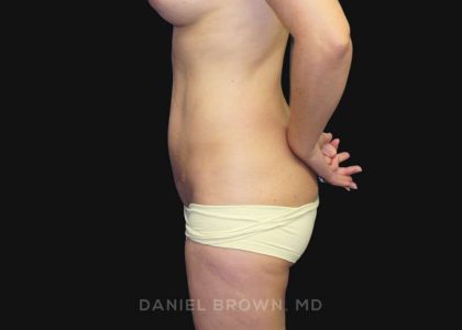 Mini Tummy Tuck Before & After Patient #10342