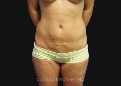 Mini Tummy Tuck Before & After Patient #10342