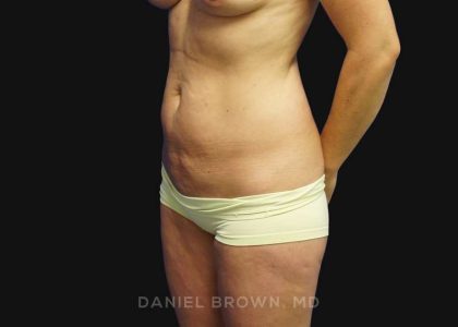 Mini Tummy Tuck Before & After Patient #10342