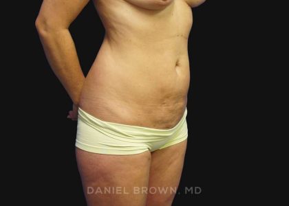 Mini Tummy Tuck Before & After Patient #10342
