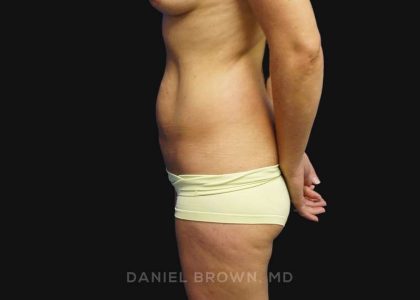 Mini Tummy Tuck Before & After Patient #10342