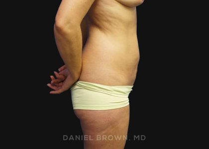 Mini Tummy Tuck Before & After Patient #10342