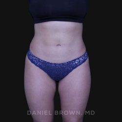 Liposuction Before & After Patient #10246