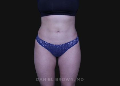 Liposuction Before & After Patient #10246