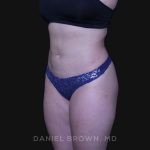 Liposuction Before & After Patient #10246