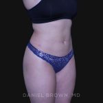 Liposuction Before & After Patient #10246
