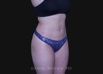 Liposuction Before & After Patient #10246