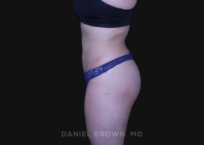 Liposuction Before & After Patient #10246