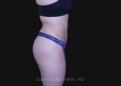 Liposuction Before & After Patient #10246