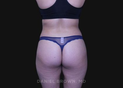 Liposuction Before & After Patient #10246