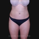 Liposuction Before & After Patient #10246
