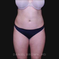Liposuction Before & After Patient #10246