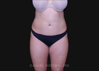 Liposuction Before & After Patient #10246
