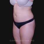 Liposuction Before & After Patient #10246